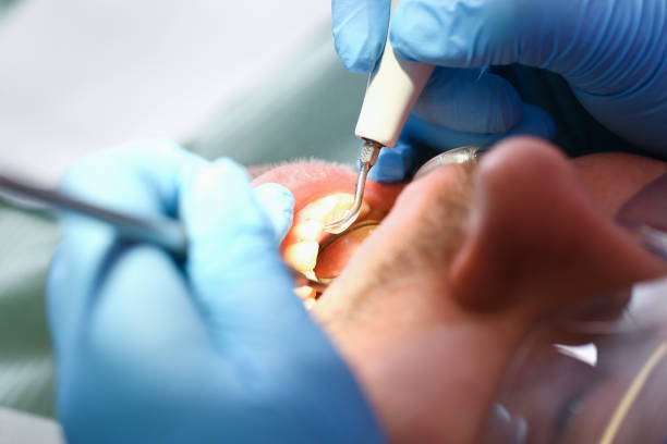 Best Emergency Tooth Extraction in Trumbull Center, CT
